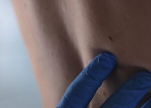 Hautkrebsscreening
